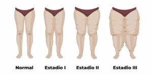 estadios-lipedema